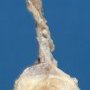 Testicular hypoplasia in cryptorchidism