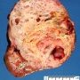 Cystic Wilms tumor