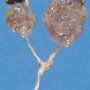 Bilateral multicystic kidneys