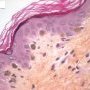Griscelli syndrome - Skin