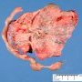 Umbilical cord stricture with fetal death