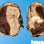 Subcapsular hemorrhage complicating a Wilms tumor