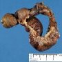 Intestinal invagination and perforative necrosis on Meckel diverticula