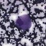 Gaucher cell in bone marrow cytology