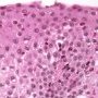 Eosinophilic oesophagitis
