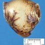 Intestinal duplication cyst