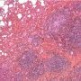 Pulmonary nodular lymphoid hyperplasia