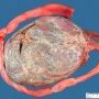 Velamentous insertion of umbilical cord
