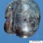 Testicular hemorrhagic necrosis in testicular torsion