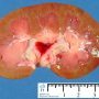 Kidney (Mild congestion)