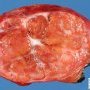 Focal nodular hyperplasia