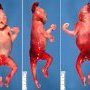 Bilateral nephromegaly with abdominal distension in Meckel syndrome