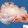 Osteochondroma