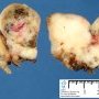 Peritoneal desmoplastic small round cell tumor