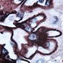 Membranous glomerulonephritis (silver stain)