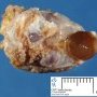 Thyroglossal tract cyst