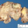Plexiform neurofibroma in neurofibromatosis type 1 (NF1)