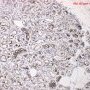 GLUT1 positivity in nfantile hemangioma
