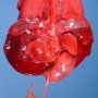 Uniateral renal agenesis in a malformative syndrome