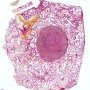 Pulmonary localization of an Hodgkin lymphoma