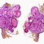 Pilomatrixoma