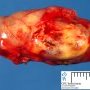 Cellular schwannoma