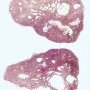 Colorectal juvenile polyp
