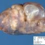 Subpleural bulla