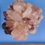 Botryoid embryonal rhabdomyosarcoma of the nasopharynx