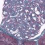Glomerular mesangiolipidosis in Alagille syndrome