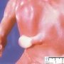 Pfeiffer syndrome