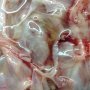 Ovarian mucinous cystadenoma