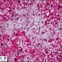 Portal macrophagic infiltration in Wolman disease-CESD