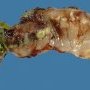 Neonatal necrotizing enterocolitis
