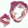 Neonatal necrotizing enterocolitis