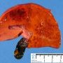 Hepatic ischemia in a systemic sepsis