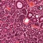 Pancreatic acinar cell carcinoma