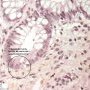 Inflammatory apoptotic cells in chronic colitis (Legends)
