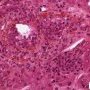 Acute cholangitis