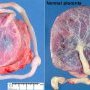 Circumvallate placenta (with control)