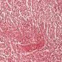 Focal myocardial infarction in thrombotic microangiopathy