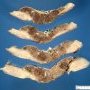 Placenta percreta