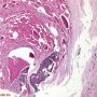Nail involvment in psoriais