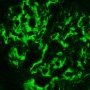IgA mesangial deposits (IgA nephropathy)