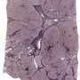 Focal nodular hyperplasia