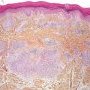 Dermal epithelioid granulomas