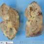 Renal tuberculosis