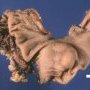 Gastric GIST