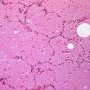 Adult alveolar proteinosis