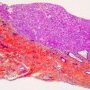 Ductal plate malformation (congenital hepatic fibrosis)